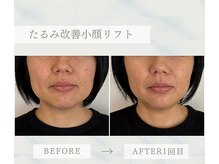 ソラ(Sola)/たるたるみ改善小顔リフト
