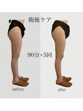 ファミーユ 豊橋店/【術後ケア】太もも吸引後ケア