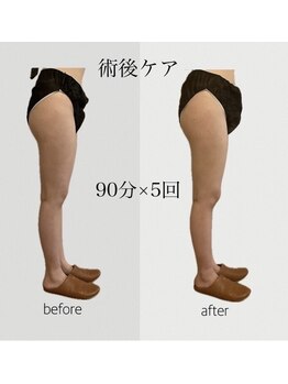 ファミーユ 豊橋店/【術後ケア】太もも吸引後ケア