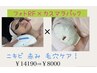 フォトRF×カスマラパックでニキビケア！　12100円→7900円