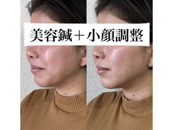 つばさ鍼灸院/1回の効果