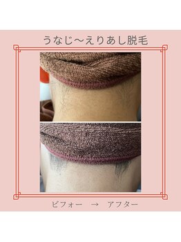 ノノ(nono)/えりあし脱毛