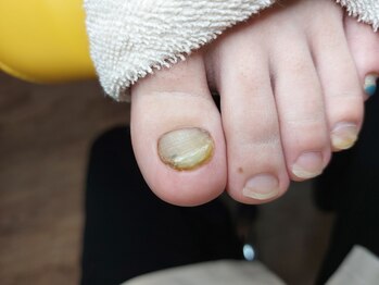 爪切り屋 足楽/肥厚爪　【before】