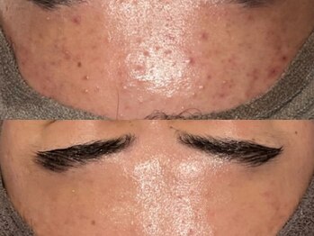 ルース 白河店(LUZ)/ニキビ・赤み症例写真