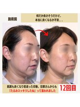 経堂鍼灸整体院/幹細胞美容鍼＋小顔矯正