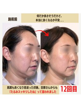 経堂鍼灸整体院/幹細胞美容鍼+小顔矯正