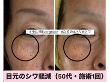 エバーグリーン(Evergreen)/シワたるみ改善はコラーゲン生成