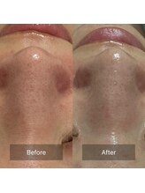 マヴィ(Mavie)/ハーブピーリング　Before After