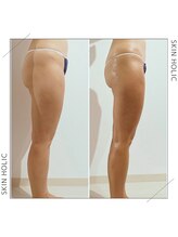 スキンホリック 恵比寿駅前店(SKIN HOLIC)/脚☆引締めビフォア＆アフター★