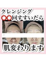 ホワイトアクア 梅田本店(WHITE AQUA)/ララピール/大阪/梅田/毛穴/小顔