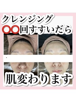 ホワイトアクア 梅田本店(WHITE AQUA)/ララピール/大阪/梅田/毛穴/小顔