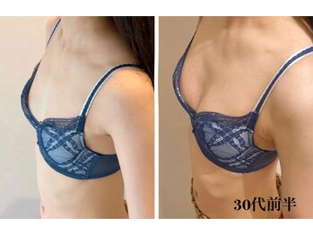 リール 新宿店(RIRE)/30代前半 バストアップ症例