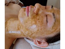 ヨリーズサロン(yoris.salon)/小顔も叶う◎碧ハーブピーリング