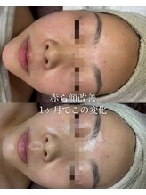 ココリール/赤ら顔・乾燥肌