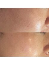 ラウレア(Laule'a)/津山｜毛穴改善例