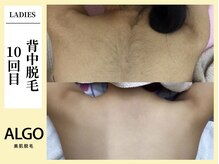 アルゴ 飯塚店(ALGO)/背中脱毛