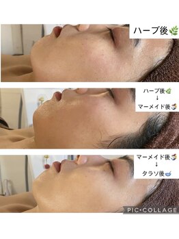 キコ リラクゼーションサロン(KICO by PLUS)/肌質改善フェイシャル