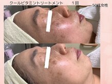 フォーユー マシバメディカル(For You Mashiba Medical)の雰囲気（年齢肌悩みに◎しっとりもちもち肌のトーンも上がってシミ改善）