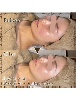 プライベートサロン レイ(Ray)/毛穴コースとオプションフット