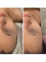 ウィズ(with)/REVIハーブピーリング