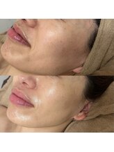 アンドミー(and me)/鹿児島/唐湊/光フェイシャル