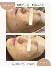 クオーレ ハギワラ(cuore HAGIWARA)/肌質改善/しみ・くすみ