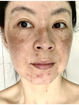 福岡美人工房 アロマムーン/ハーブピーリングと出会う前の私