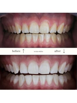 エクシアホワイトニング 沖縄宮里店/お客様ビフォア