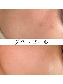 アウラ(AURA)/ダクトピール before/after