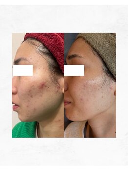 アルル 甲賀(ARuru)/肌改善セミファイナリスト受賞！