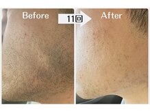 ルタンリッシュオム(Lutan Riche hom)/ヒゲ脱毛　途中経過