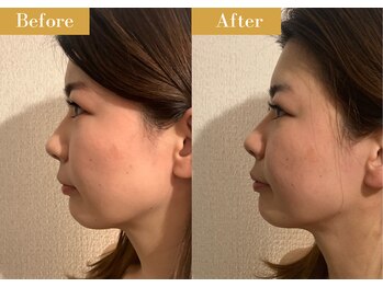モモスパ(MOMOspa.)/頭蓋骨小顔矯正ビフォアフター