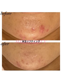 サロンヴェアリー 広尾(salon vary)/水玉リフティング　#ニキビケア