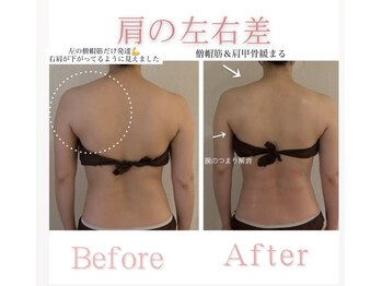 アティレ オオサカ(Attirer Osaka)/酷い肩凝り＆左右差