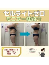 アヤエステティックサロン 綱島店(AYA)/モニター様【セルライトゼロ】