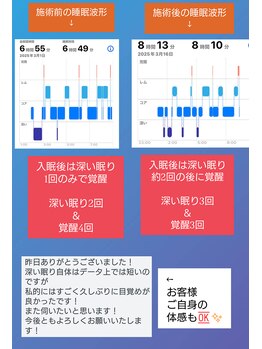 ぐっすりん/施術前と施術後の睡眠波形の変化