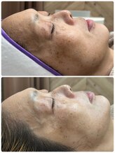 ビープラス(Biplus)/マリムーブフェイシャルワックス