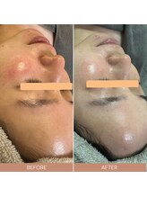 ルルーディア(LOULOUDIA)/赤ら顔改善、美肌ケア♪