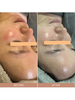 ルルーディア(LOULOUDIA)/赤ら顔改善、美肌ケア♪