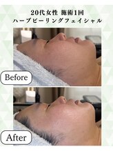 シーフェイス 横浜店(SEE FACE)/毛穴と小顔を同時に改善！ハーブ