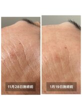 雪中花ナルシサス(narcisse)/ひたいの横シワ・乾燥