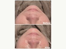 アンフェム(Anfem)/レモンボトル＋ブースターW導入