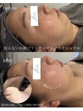 ユフラ(Juhla)/切らない小顔リフトサーマル