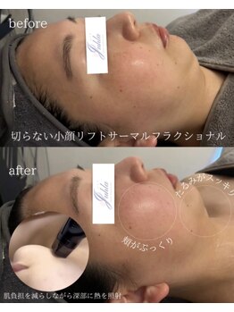 ユフラ(Juhla)/切らない小顔リフトサーマル