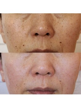 トラット エステアンドアイズ(tratto)/50代　お客様症例写真