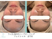 フローレ 平針店(Flore)/くすみ・シミ・美白ケアに