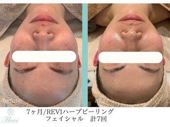 フローレ 平針店(Flore)/くすみ・シミ・美白ケアに