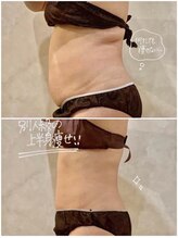 OBS新潟整骨院/脂肪冷却　Before＆After
