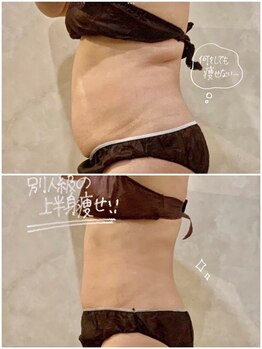 OBS新潟整骨院/脂肪冷却　Before＆After