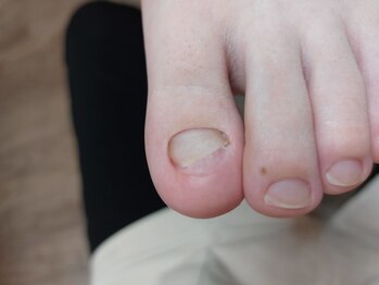 爪切り屋 足楽/肥厚爪　【after】